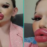 Vrouw met 'de grootste lippen ter wereld' krijgt nog meer behandelingen