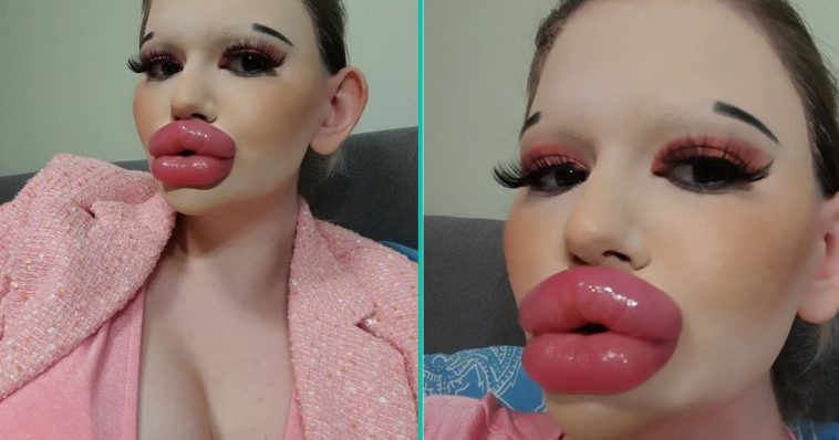 Vrouw met 'de grootste lippen ter wereld' krijgt nog meer behandelingen