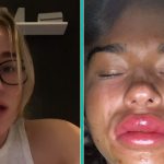 Vrouw die lipfiller behandeling gedaan heeft ervaart buitengewone pijn na een glaasje wijn
