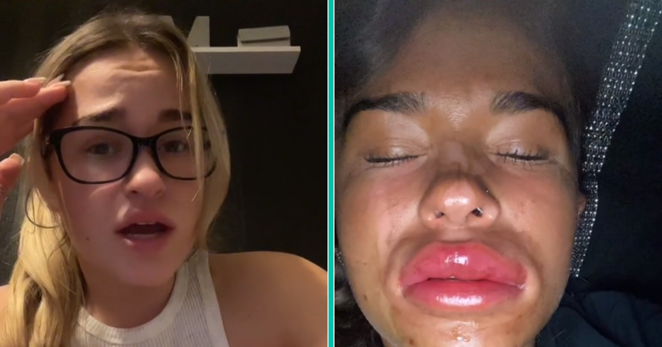 Vrouw die lipfiller behandeling gedaan heeft ervaart buitengewone pijn na een glaasje wijn