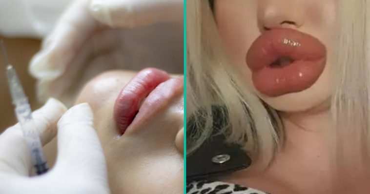 Dit zijn de grootste lippen van de 'lipfiller' trend
