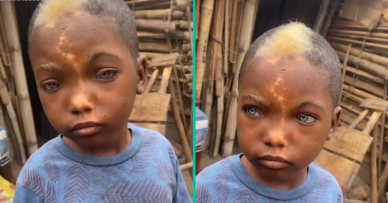 Afrikaanse peuter met blauwe ogen en unieke 'bliksemkenmerk' op zijn gezicht zet de wereld op zijn kop!