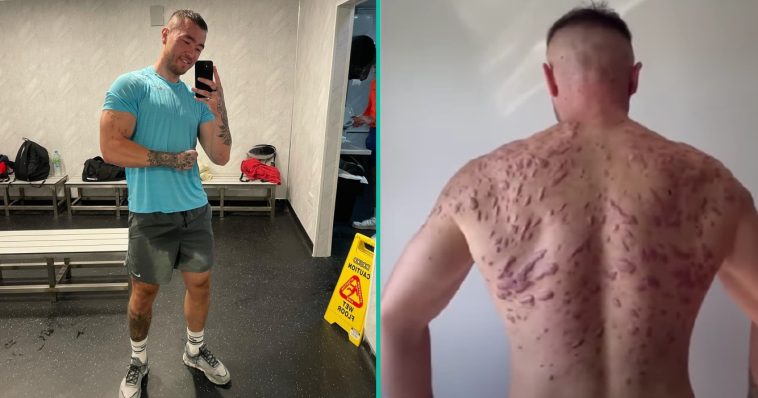 Bodybuilder toont ernstige schade van steroïden aan zijn lichaam om anderen te waarschuwen